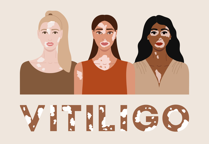 vitiligo