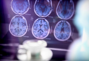 investigación Alzheimer