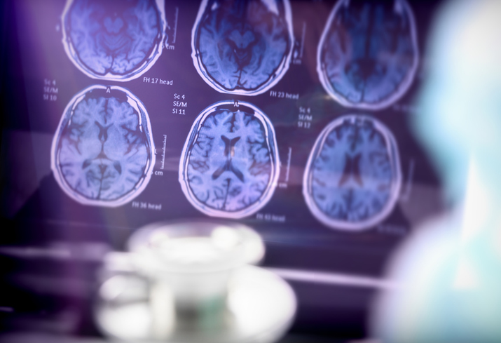investigación Alzheimer