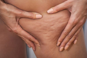 celulitis