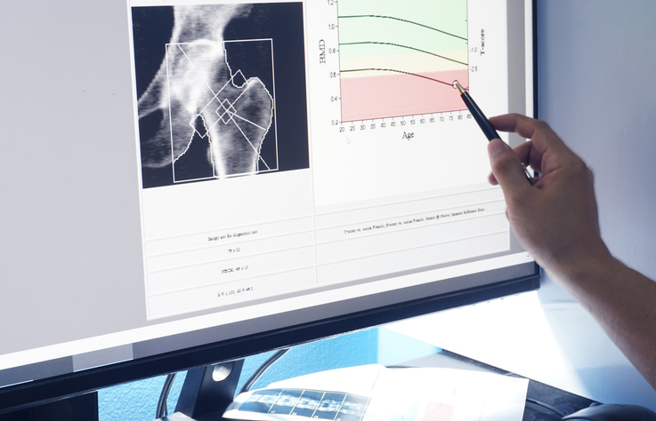 observatorio osteoporosis