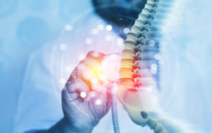 radiculopatia
