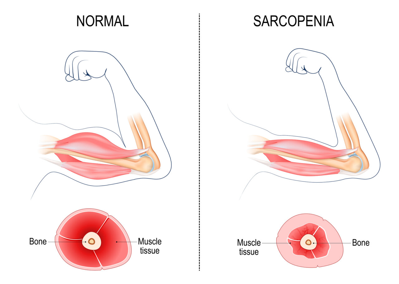 sarcopenia