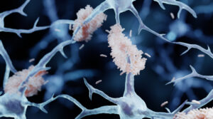 alzheimer