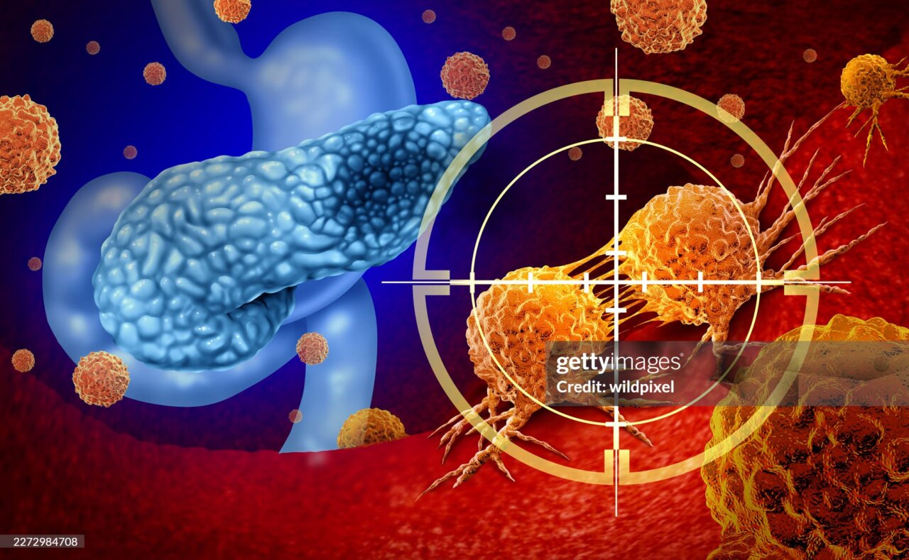 cáncer páncreas